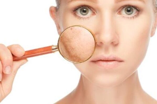 Alergia en la cara por estrés