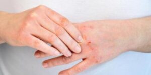 Alergia en las manos por estrés