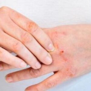 Alergia en las manos por estrés