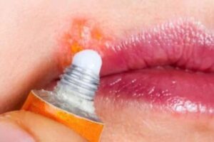 Alergia en los labios por estrés