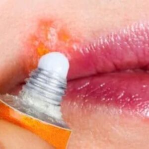 Alergia en los labios por estrés
