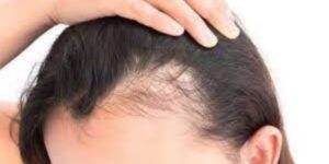 Alopecia femenina por estrés