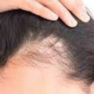 Alopecia femenina por estrés