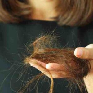 Alopecia por estrés
