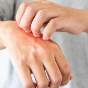 Pitiriasis rosada causas estrés