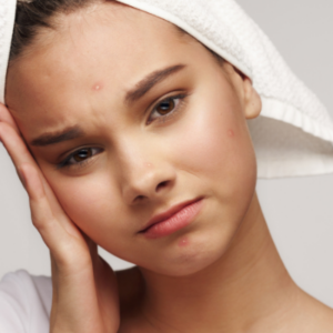 Urticaria En La Cara Por Estrés