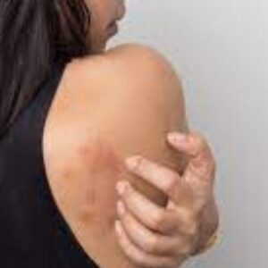 Urticaria por estrés síntomas