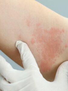 Comezon en el cuerpo por estrés