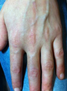 Dishidrosis eczema manos estrés