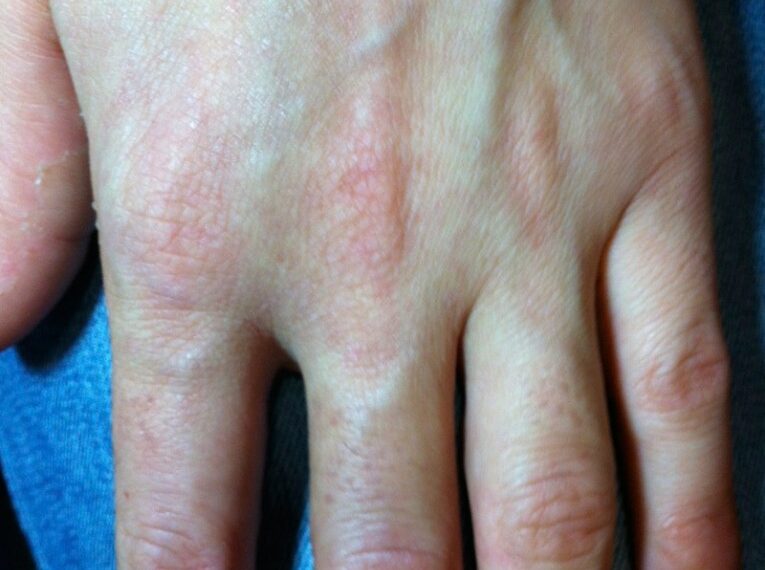 Dishidrosis eczema manos estrés