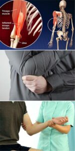 Tendinitis dolor brazo izquierdo por estrés