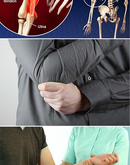 Tendinitis dolor brazo izquierdo por estrés