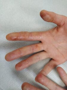 Ampollas en los dedos de la mano por estrés