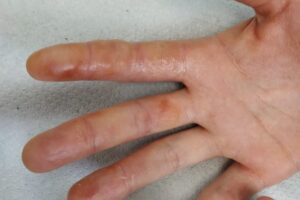 Ampollas en los dedos de la mano por estrés