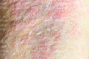 Dermatitis atópica por estrés