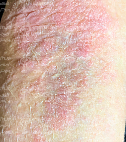 Dermatitis atópica por estrés