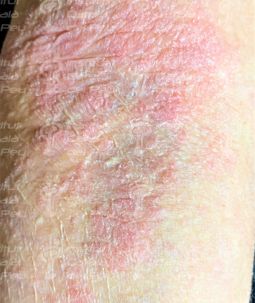 Dermatitis atópica por estrés