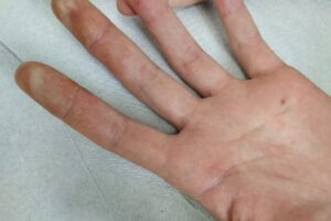 Dermatitis en manos por estrés
