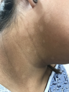 Dermatitis manchas blancas en la piel por estrés