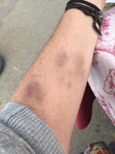 Paniculitis eritema nodoso por estrés