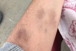 Paniculitis eritema nodoso por estrés