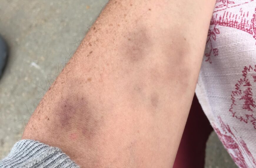 Paniculitis eritema nodoso por estrés