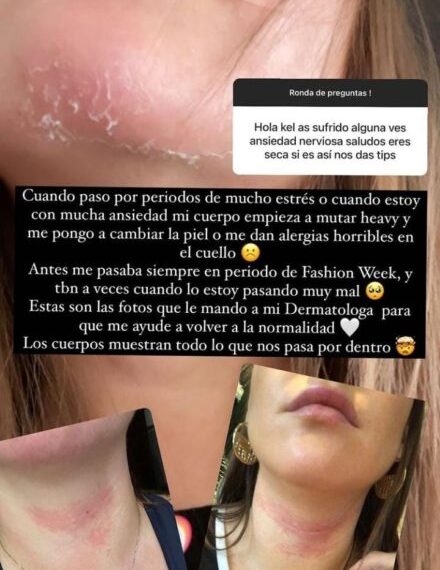 Piel como se presenta el estrés en el cuerpo