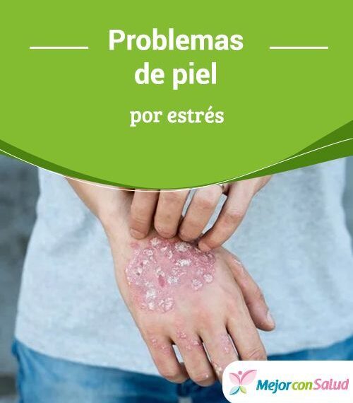 Problemas en la piel por estrés