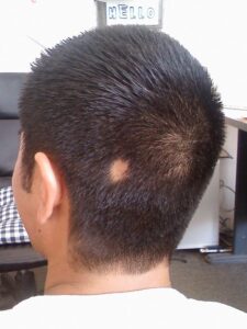 Síntomas de alopecia por estrés