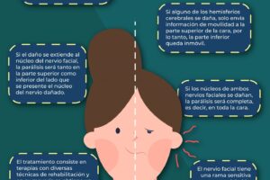 Tratamiento síntomas de parálisis facial por estrés
