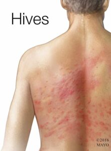 Urticaria nerviosa alergias en la piel por estrés