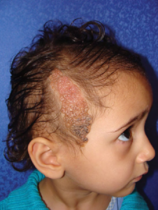 Caída de cabello en niños por estrés