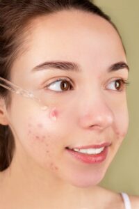 Dermatitis sarpullido en la cara por estrés