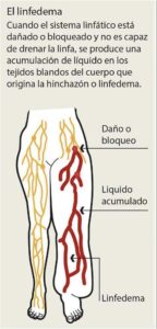 Los ganglios linfáticos se pueden inflamar por estrés