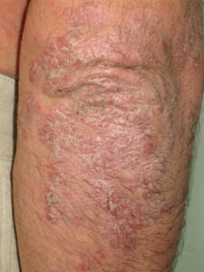 Psoriasis granos en el cuerpo por estrés