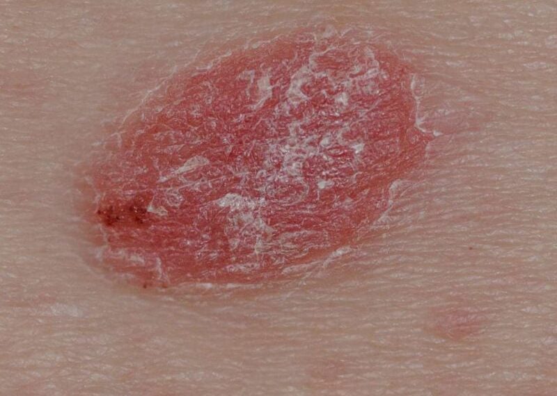 Psoriasis manchas en la piel por estrés